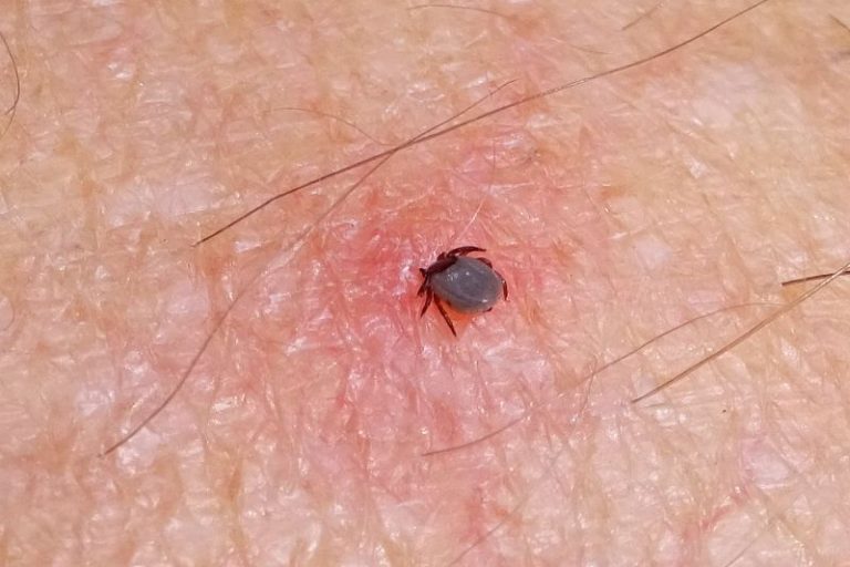 Can A Tick Fully Embedded Under Skin