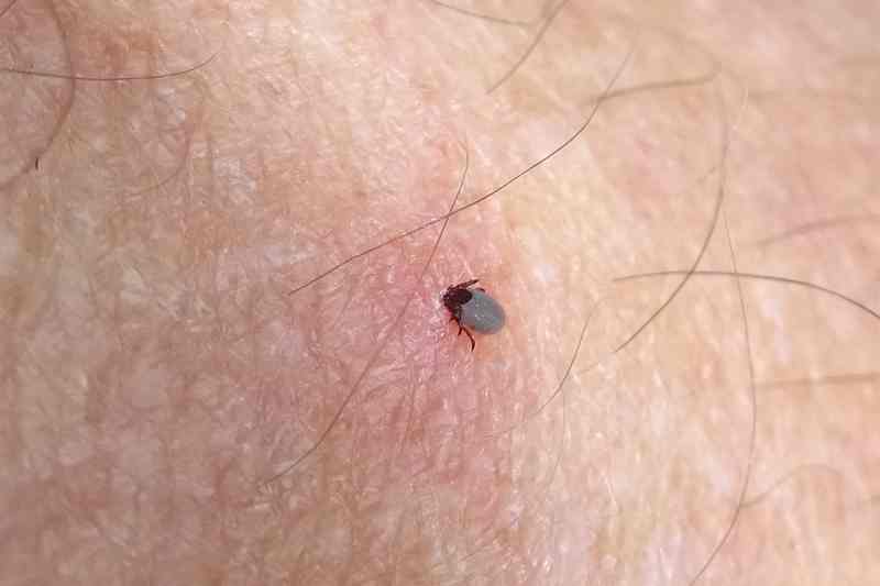 tick bites